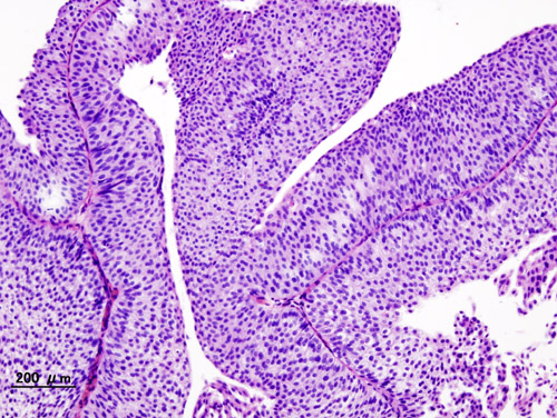 Microscopia óptica com coloração hematoxilina-eosina de carcinoma urotelial de células transicionais em biópsia transuretral, mostrando o epitélio neoplásico.