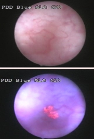 Cistoscopia de carcinoma in situ vesical: lesão plana invisível na luz branca acima e revelada em rosa pela fluorescência azul abaixo.