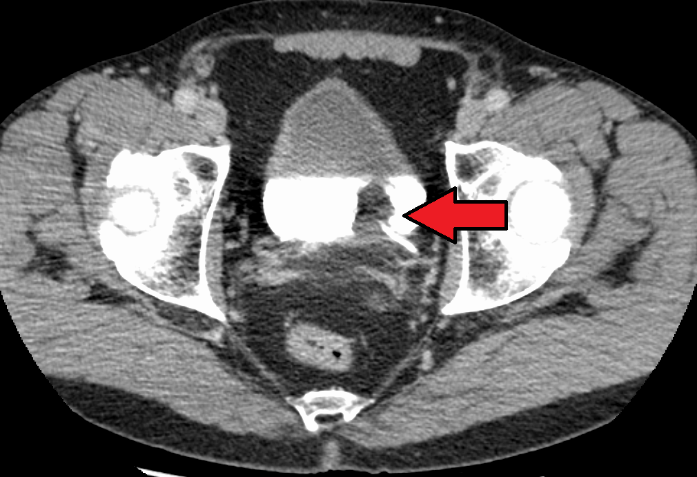 Uro-TC com contraste: a bexiga aparece preenchida de contraste branco e uma massa de carcinoma transicional aparece como falha de enchimento.