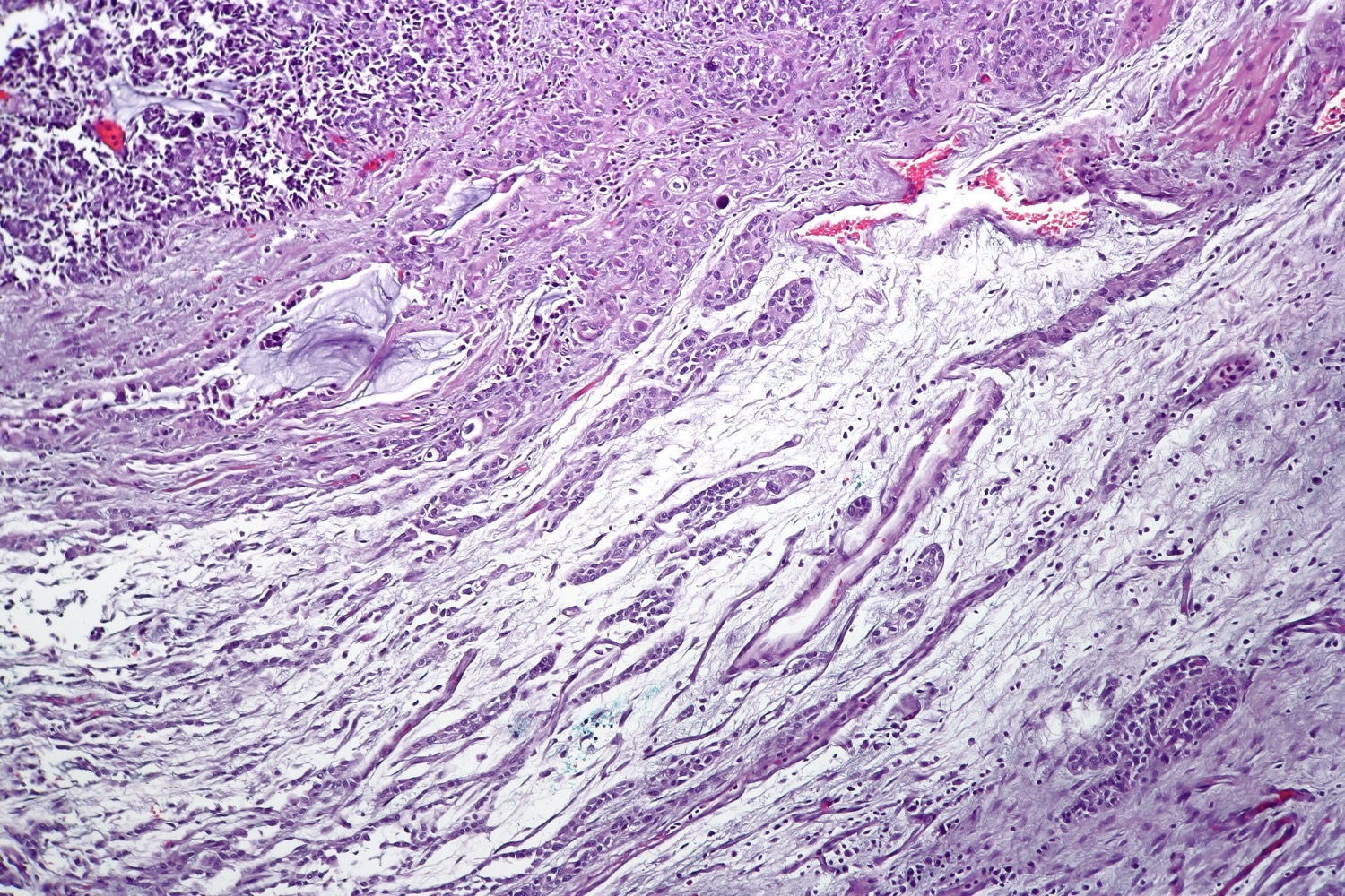 Lâmina histológica corada por HE mostrando ninhos de carcinoma urotelial infiltrando feixes de músculo liso da muscularis propria.