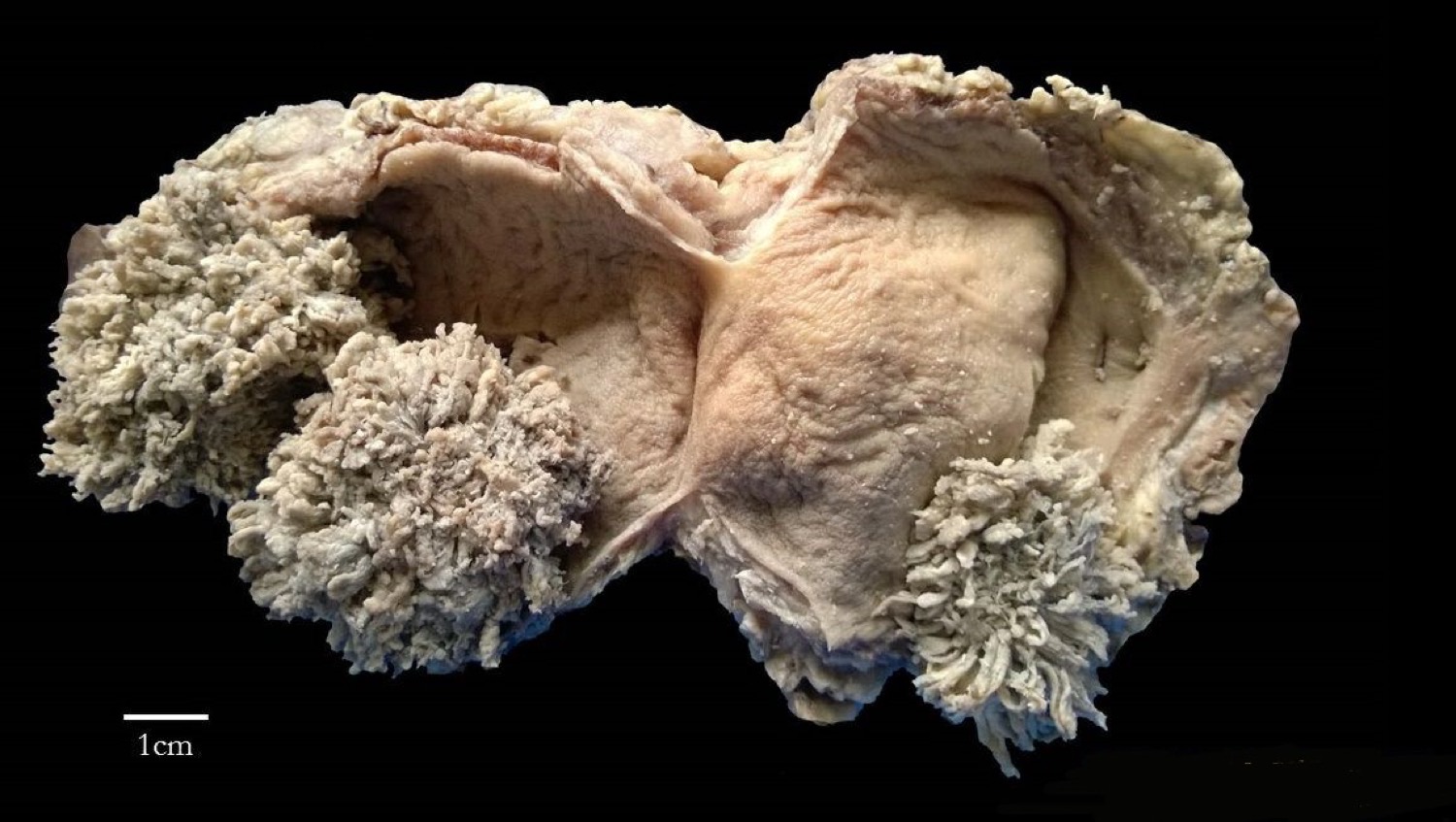 Peça de bexiga aberta mostrando tumor urotelial de aspecto papilar, com projeções frondosas para a luz vesical.