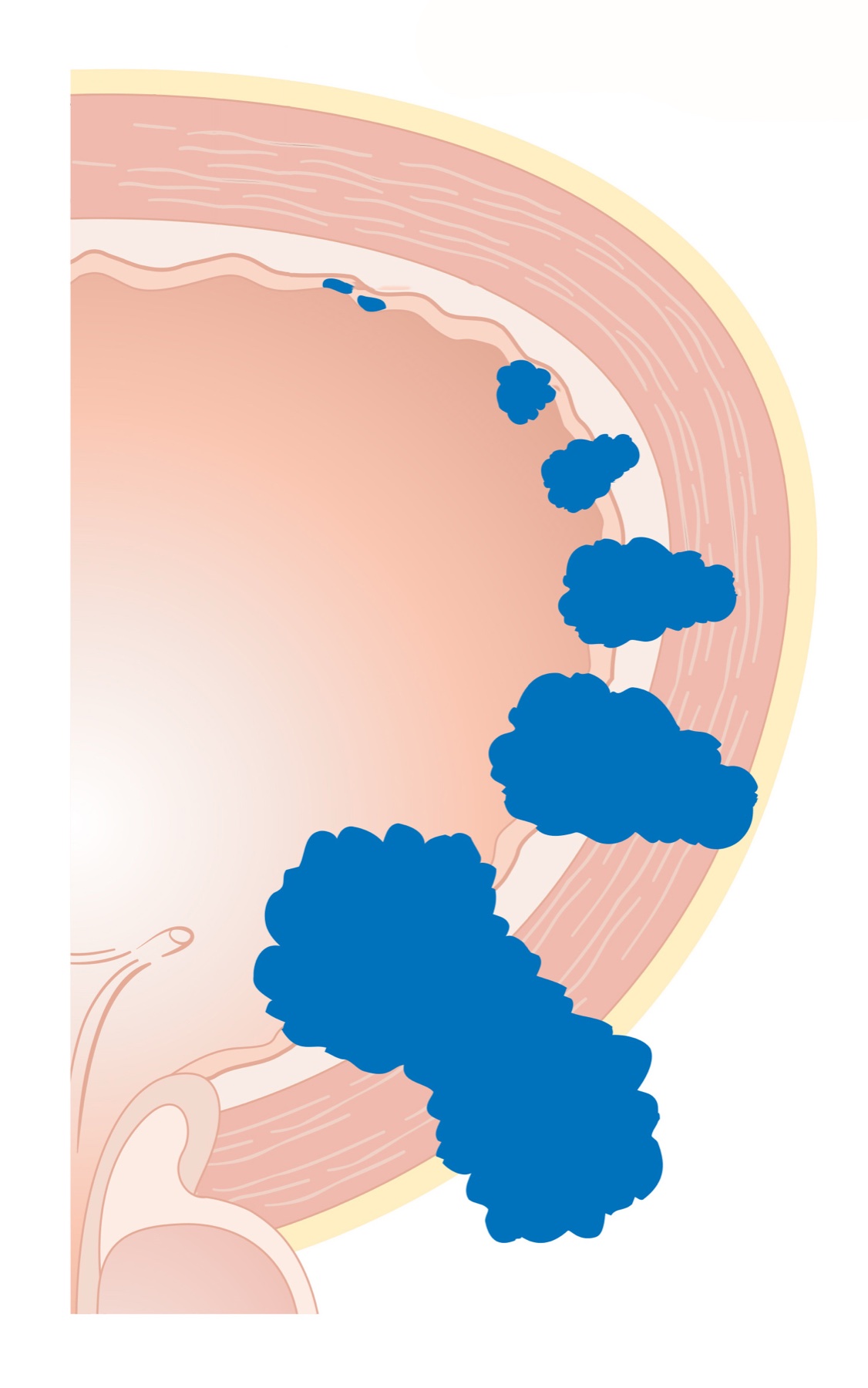 Diagrama em corte da parede da bexiga mostrando os estágios T do câncer, com o tumor invadindo camadas progressivamente mais profundas, da mucosa até órgãos vizinhos.