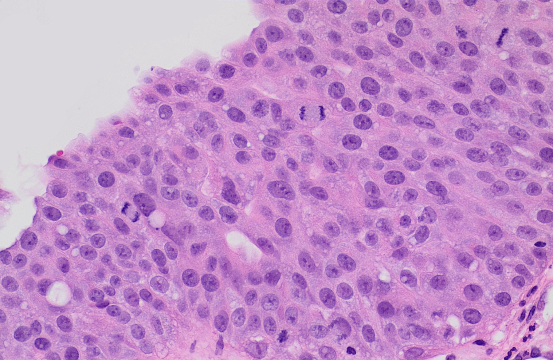 Lâmina histológica HE de carcinoma urotelial de alto grau com células desorganizadas, núcleos pleomórficos e figuras de mitose.