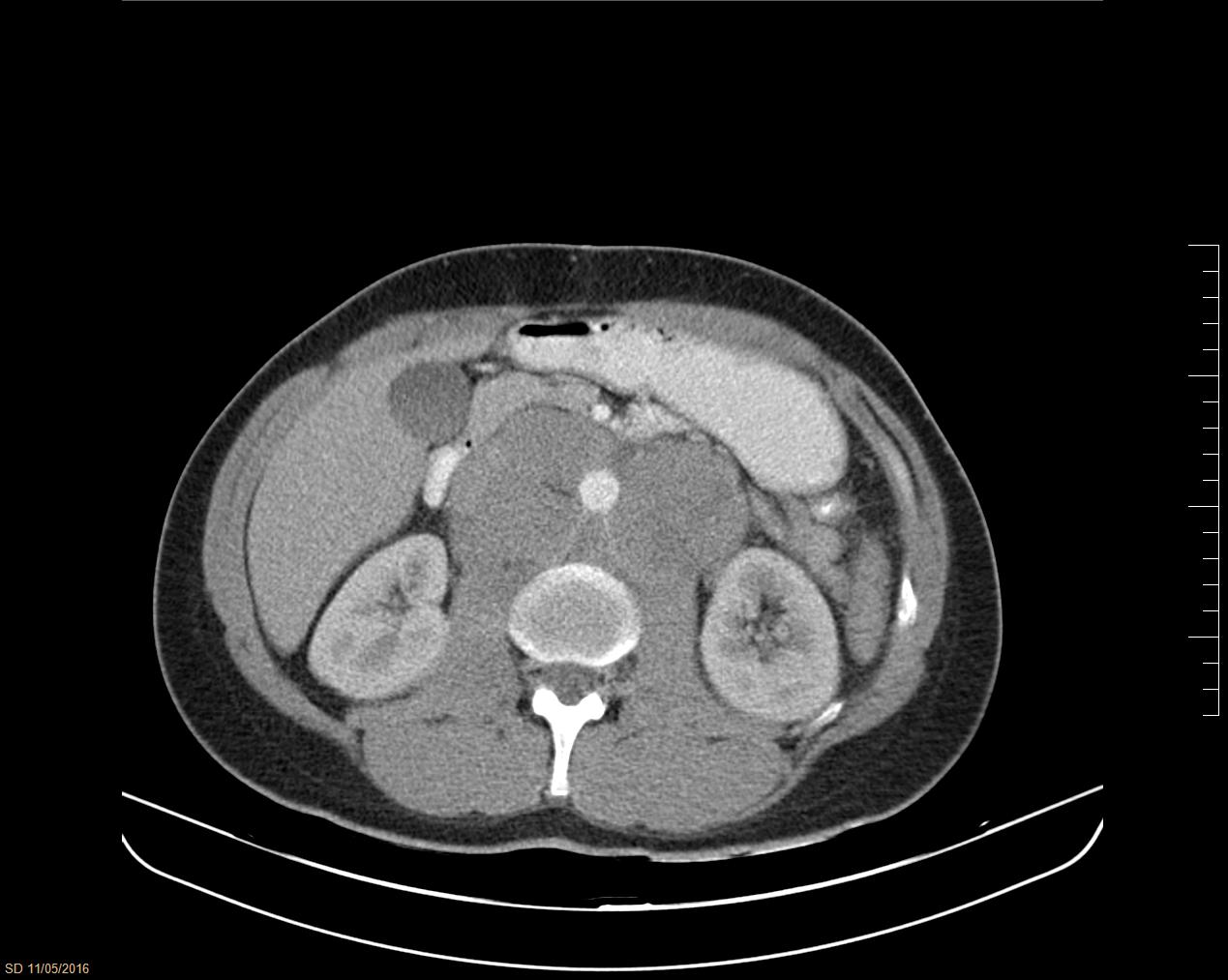 Tomografia de abdome com contraste: linfadenopatia retroperitoneal de seminoma testicular envolvendo a aorta — o achado que a TC de estadiamento busca quando o marcador não cai.