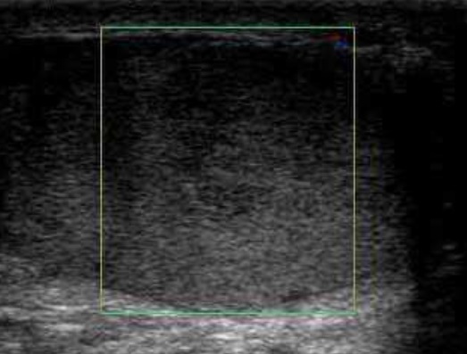 Ultrassonografia escrotal de torção testicular: dentro da caixa de Doppler colorido, ausência de fluxo no testículo — o oposto da vascularização aumentada do tumor.