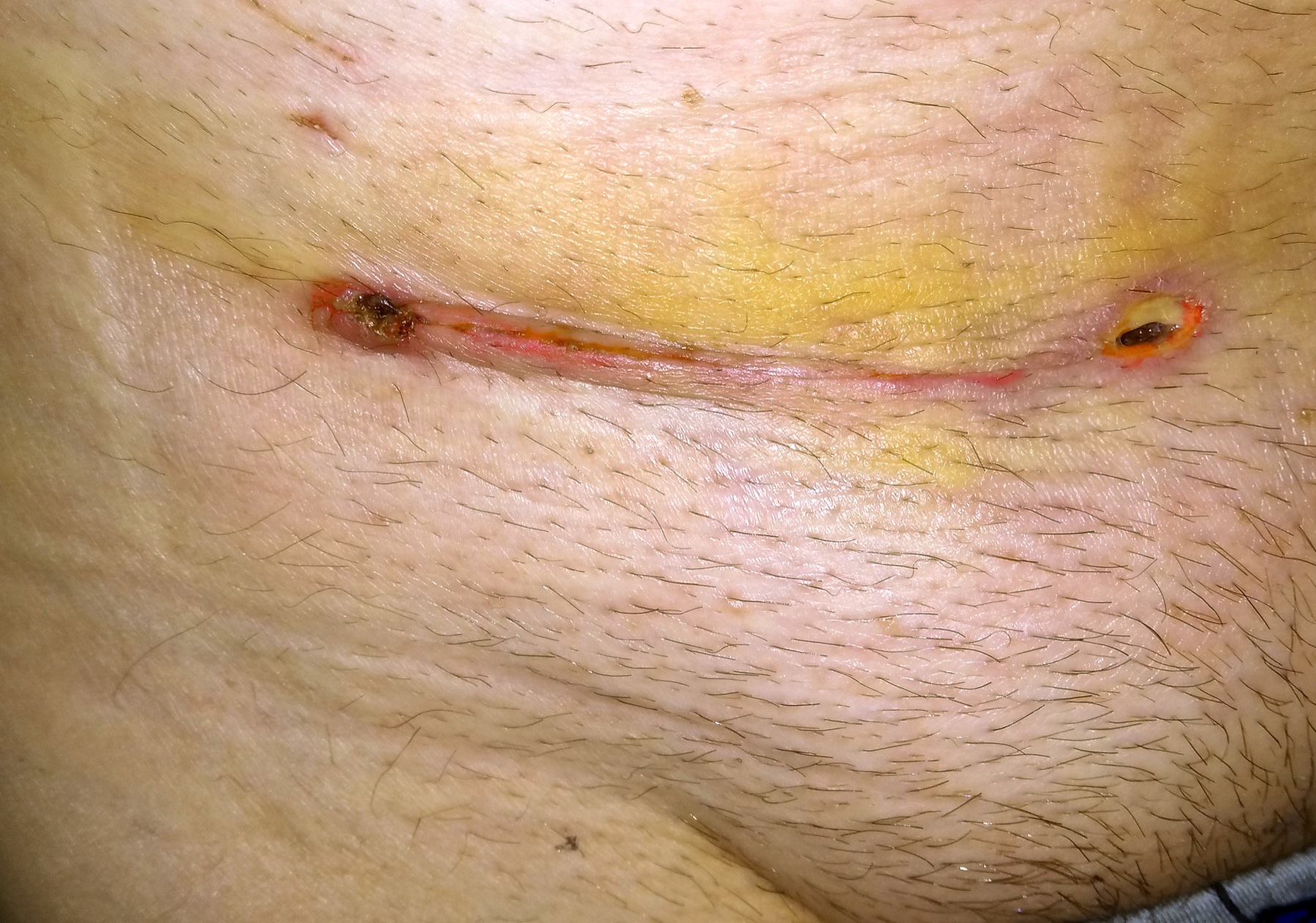 Cicatriz de orquiectomia na região inguinal — incisão na virilha, não na bolsa escrotal, marca da via inguinal radical.