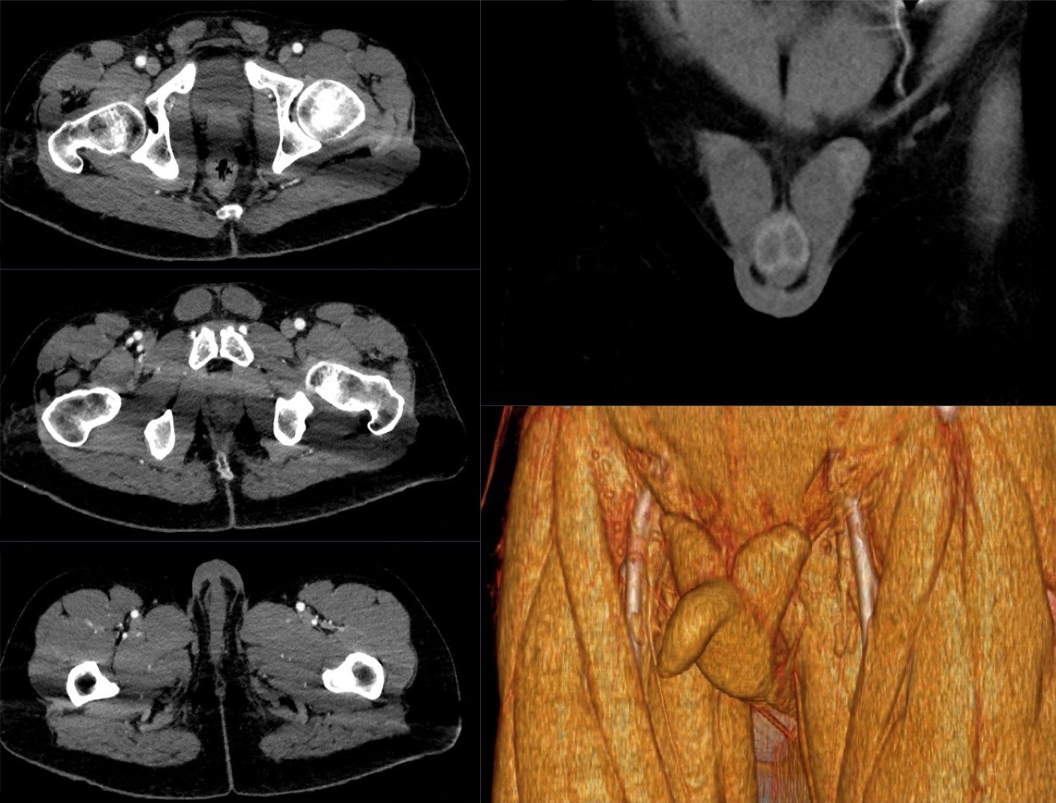 Tomografia com contraste, homem de 37 anos: testículos retidos na região inguinal bilateralmente, bolsa escrotal vazia.