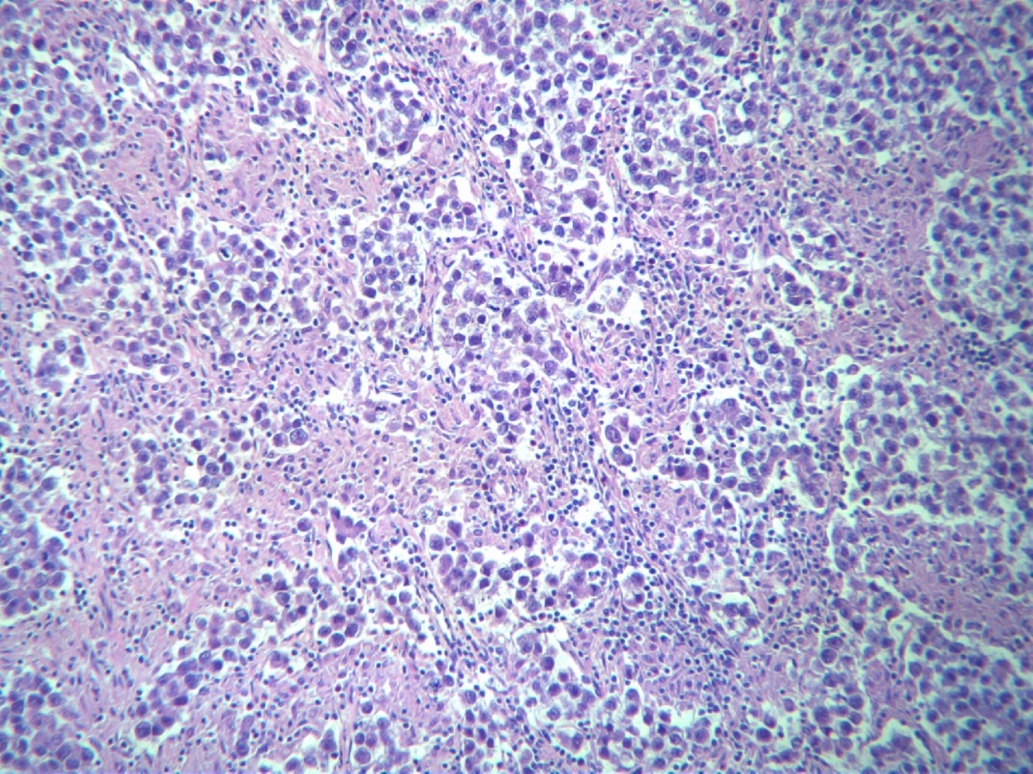 Microscopia com coloração hematoxilina-eosina de seminoma clássico: células germinativas de citoplasma claro em ninhos, separadas por septos com infiltrado linfocitário.