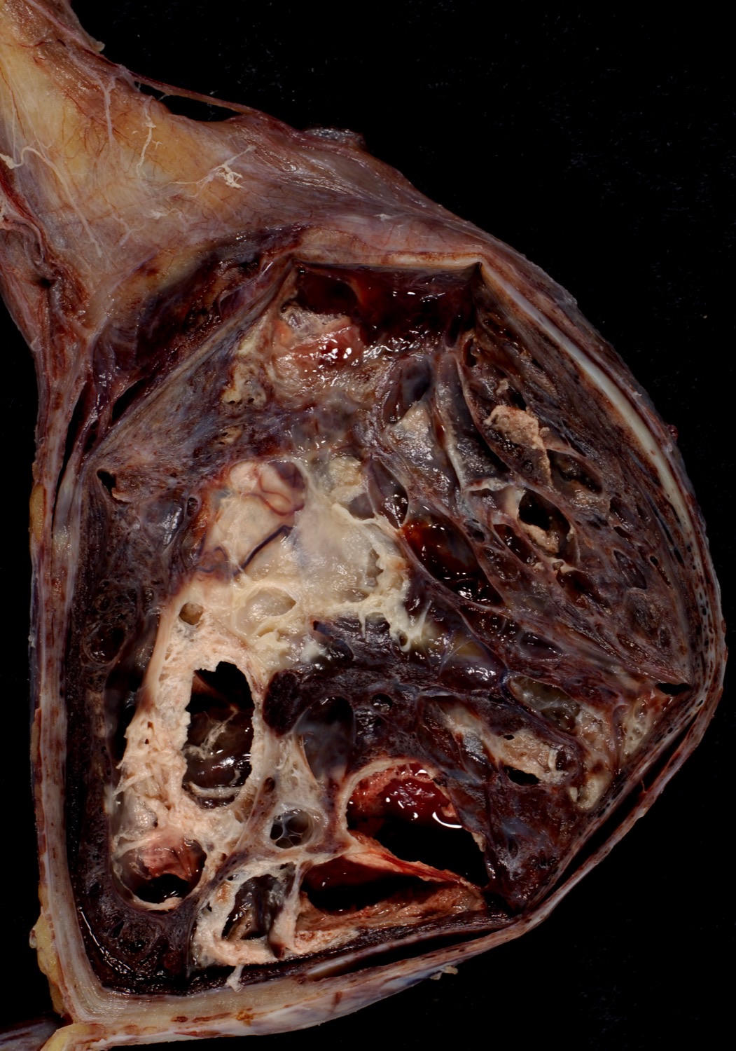 Peça macroscópica de tumor testicular: massa sólida volumosa substituindo o parênquima do testículo, em homem jovem.