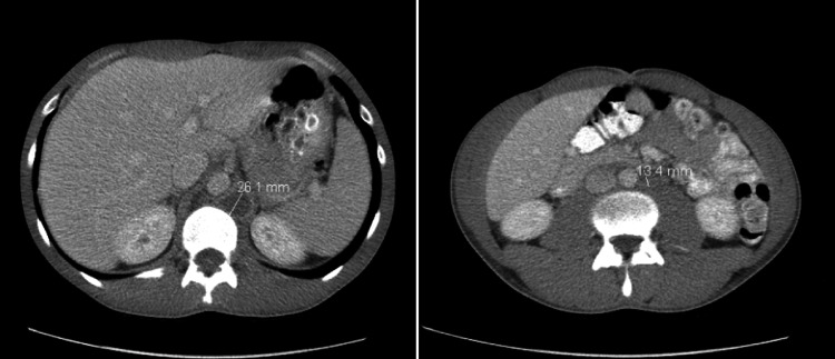 Tomografia de abdome com contraste: linfonodos retroperitoneais aumentados (cerca de 26 e 13 mm), metástase de tumor germinativo testicular — o nível para onde o tumor drena pelo canal inguinal.