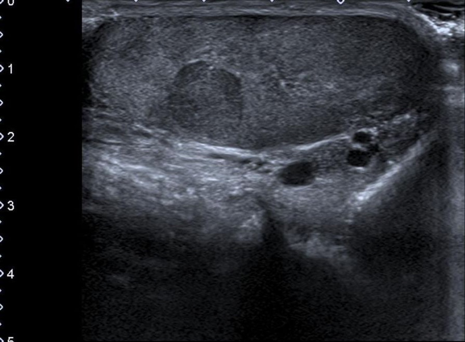 Ultrassonografia escrotal: nódulo intratesticular hipoecogênico e bem delimitado no testículo esquerdo, compatível com tumor germinativo.