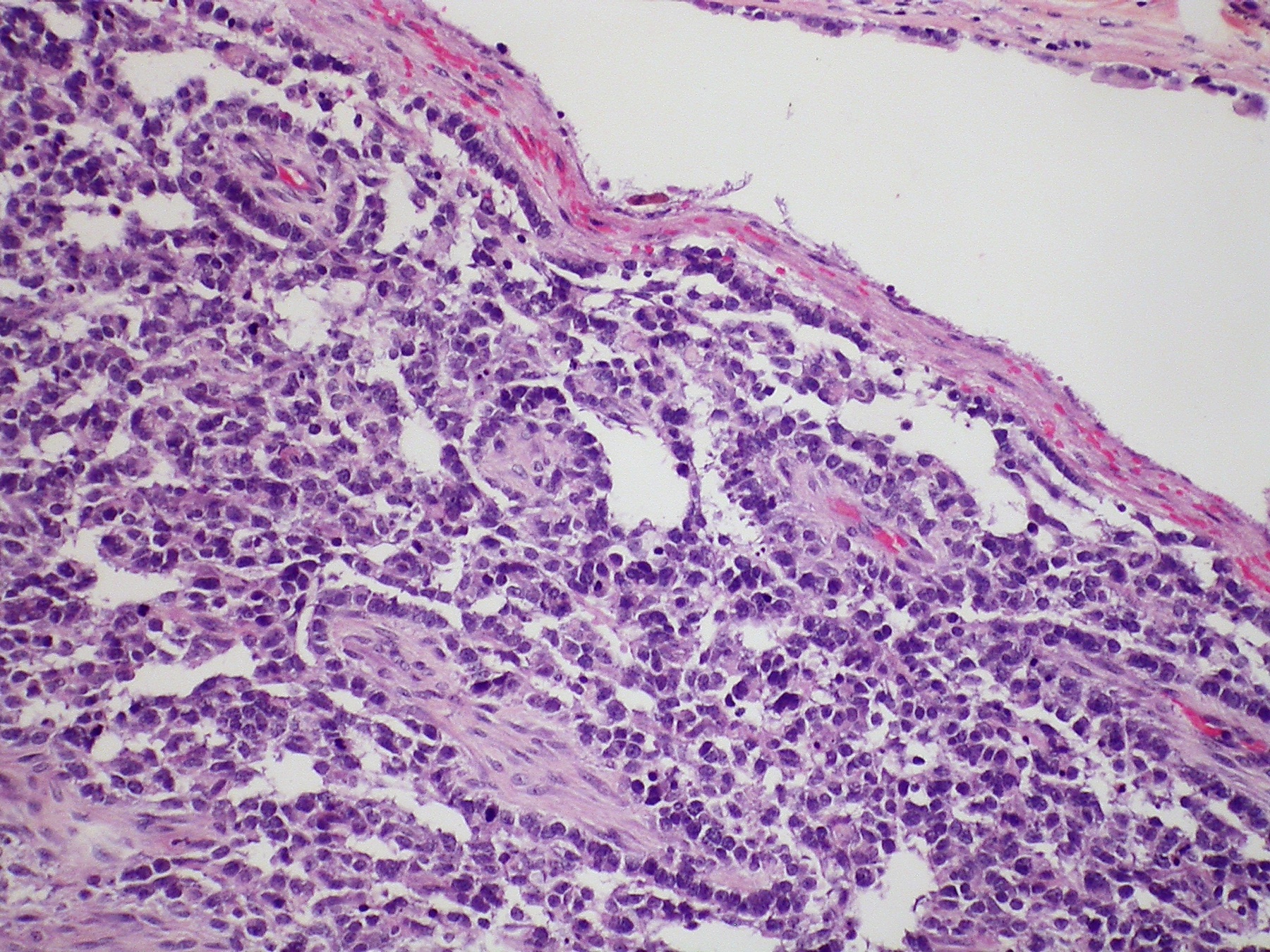 Microscopia (HE) de tumor do saco vitelínico do testículo — o componente germinativo não-seminomatoso que produz alfafetoproteína (AFP).