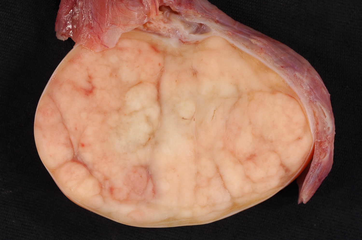 Peça de orquiectomia inguinal radical: testículo seccionado substituído por seminoma sólido e homogêneo, medindo cerca de 7 cm.