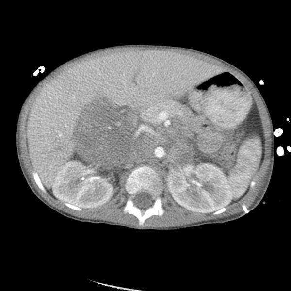 Tomografia de abdome (corte axial): massa retroperitoneal/suprarrenal heterogênea e volumosa que cruza a linha média, compatível com neuroblastoma.