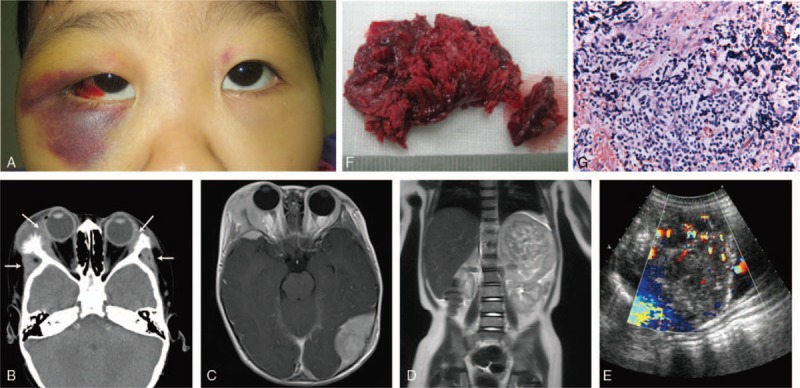 Foto clínica: criança com equimose periorbitária esquerda (sinal do guaxinim), hemorragia subconjuntival e proptose por metástase orbitária de neuroblastoma.
