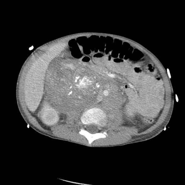 Tomografia de abdome: massa retroperitoneal de neuroblastoma com calcificações grosseiras e puntiformes no seu interior.