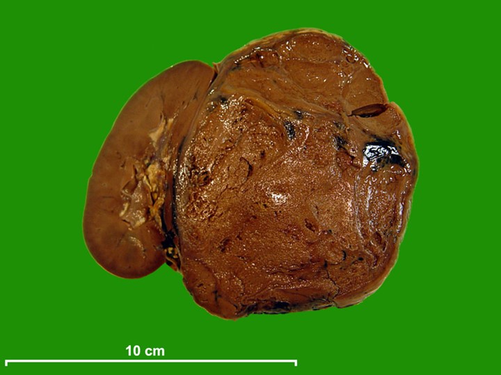 Peça de nefrectomia: tumor de Wilms volumoso, castanho e lobulado, originando-se do rim (parênquima renal residual visível à esquerda), com barra de escala de 10 cm.