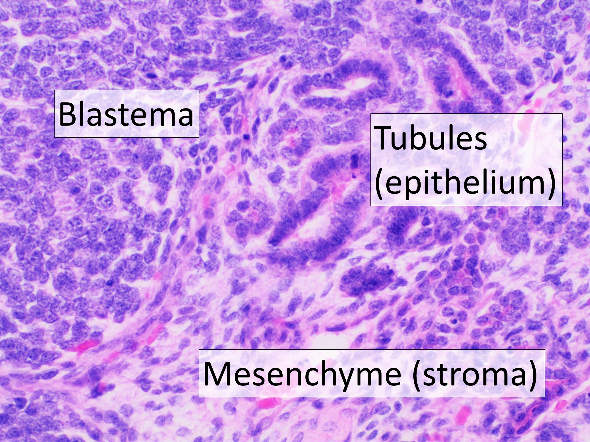 Microscopia (HE) de tumor de Wilms com padrão trifásico: blastema (células pequenas e azuis), túbulos epiteliais e estroma mesenquimal, identificados na imagem.