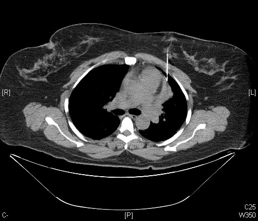 Tomografia de tórax: volumosa massa no mediastino anterior (timoma) encostando no coração e nos grandes vasos, com agulha de biópsia posicionada.