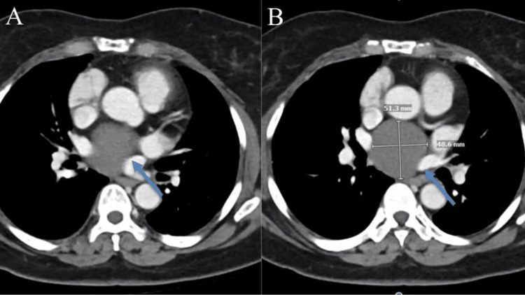 Tomografia de tórax: lesão cística subcarinal homogênea e hipodensa no mediastino médio, medindo cerca de 5 cm, sem realce — cisto broncogênico.