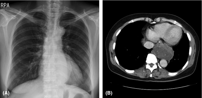 Schwannoma de mediastino posterior: radiografia de tórax PA com massa paravertebral (A) e tomografia axial com massa ovalada de cerca de 7 cm no compartimento posterior comprimindo o átrio esquerdo e o esôfago (B).