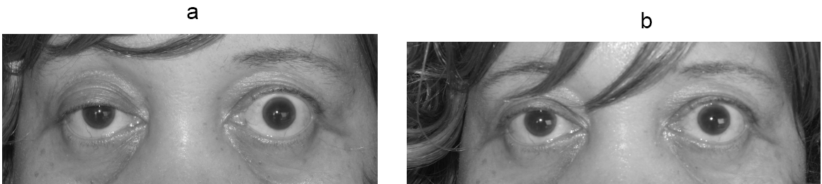 Foto clínica de miastenia gravis: ptose palpebral parcial à direita (a) que melhora após o teste do tensilon (b).