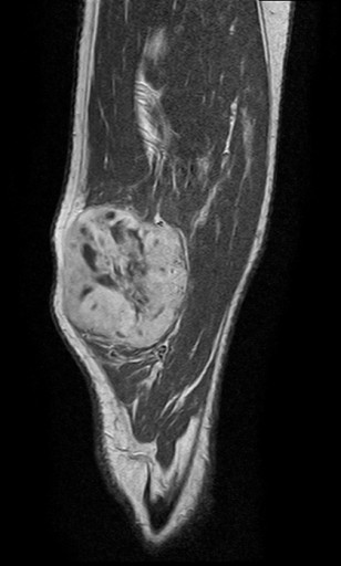 Ressonância magnética da coxa, T1 sagital com contraste: massa de partes moles heterogênea e bem delimitada no membro inferior, compatível com sarcoma de partes moles.