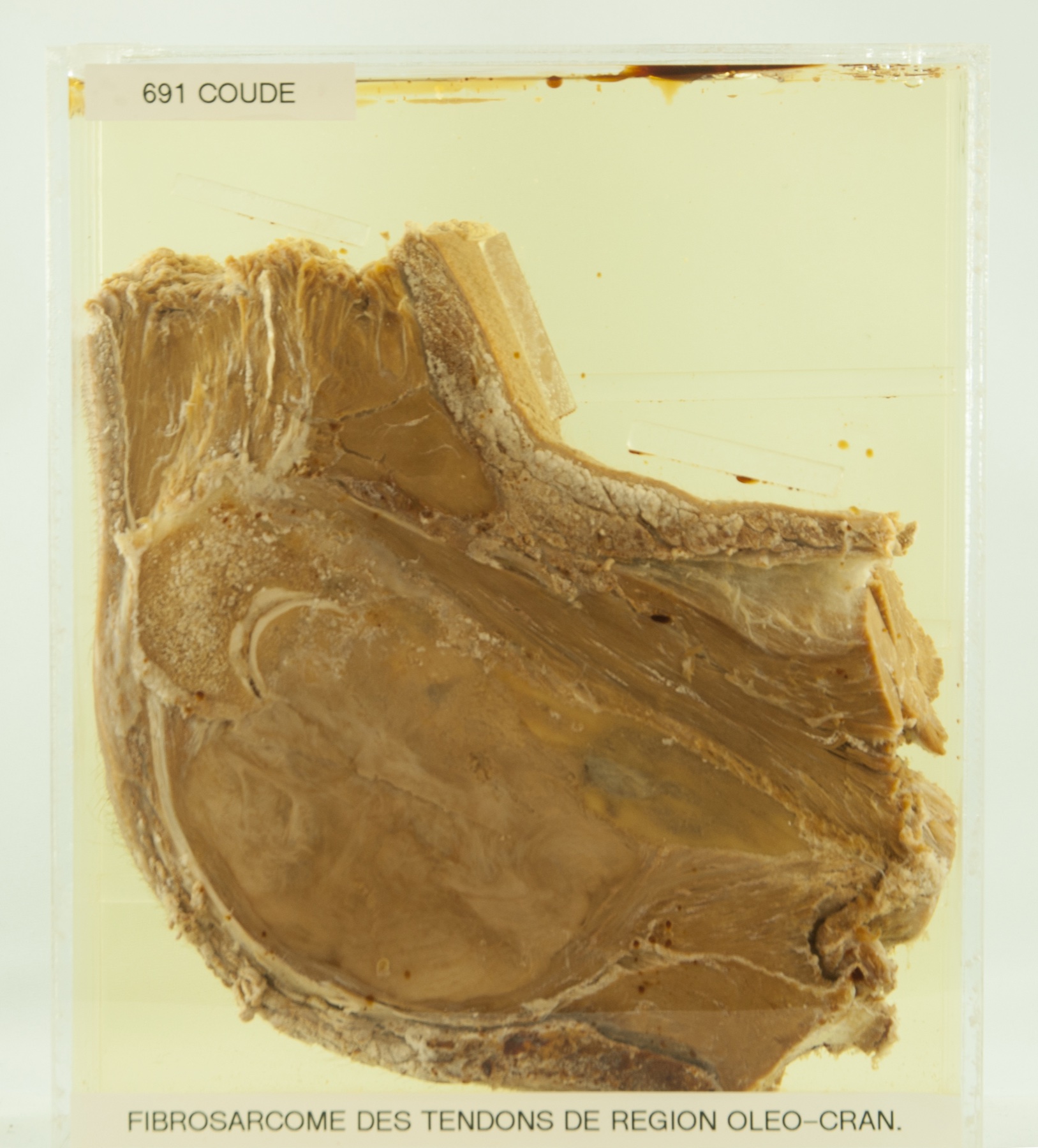 Corte anatomopatológico do cotovelo direito: fibrossarcoma dos tendões da região oleocraniana infiltrando as partes moles do membro — sarcoma de extremidade, a localização mais comum do tema.