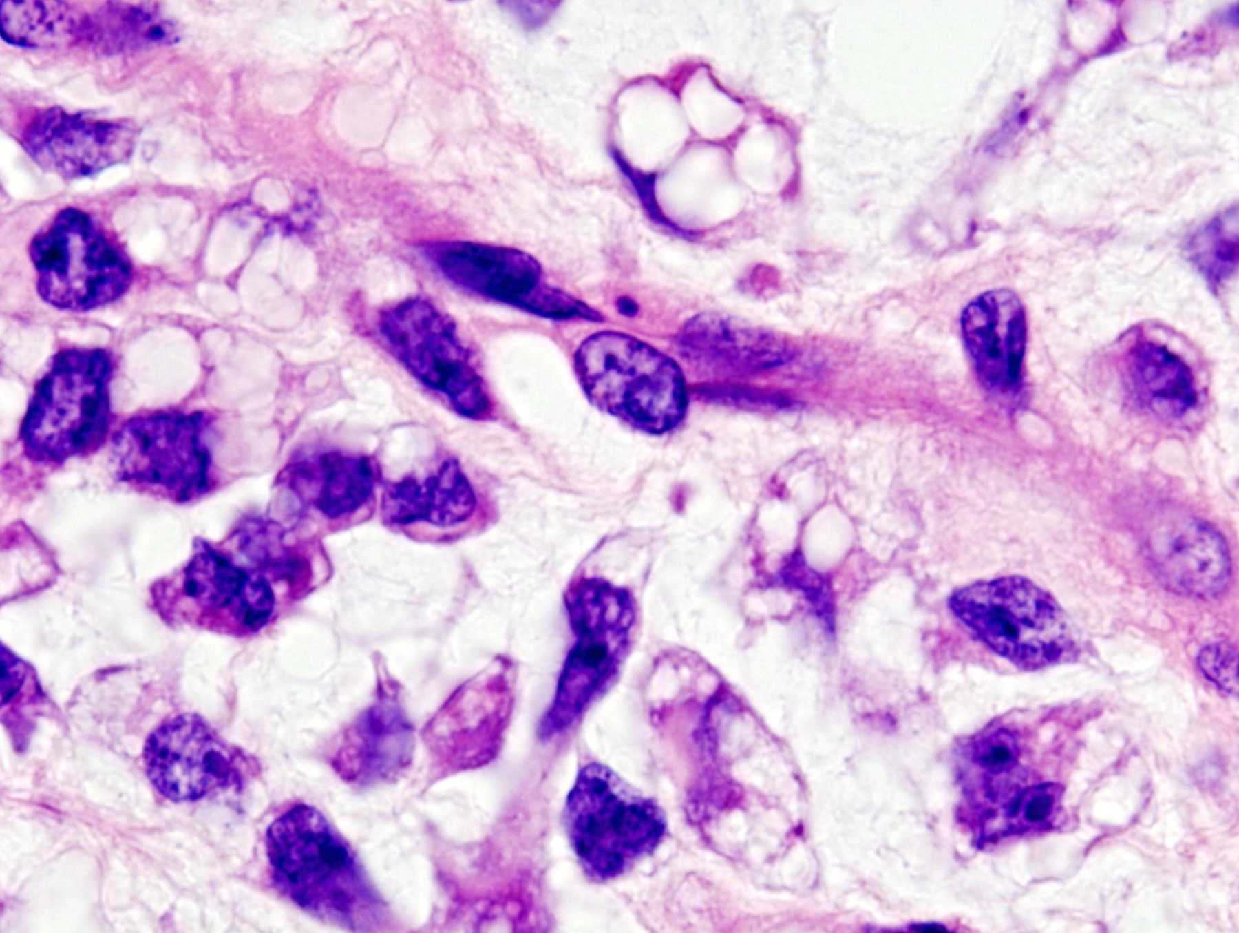 Microscopia (HE) de lipossarcoma mixoide da coxa: lipoblastos com vacúolos de gordura em estroma mixoide e rede vascular delicada.