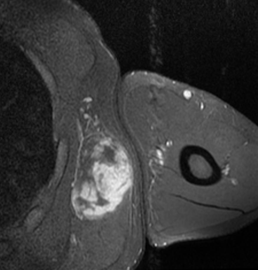Ressonância magnética, corte axial: massa de partes moles bem caracterizada na região axilar — lipossarcoma mixoide de alto grau em homem de 40 anos.