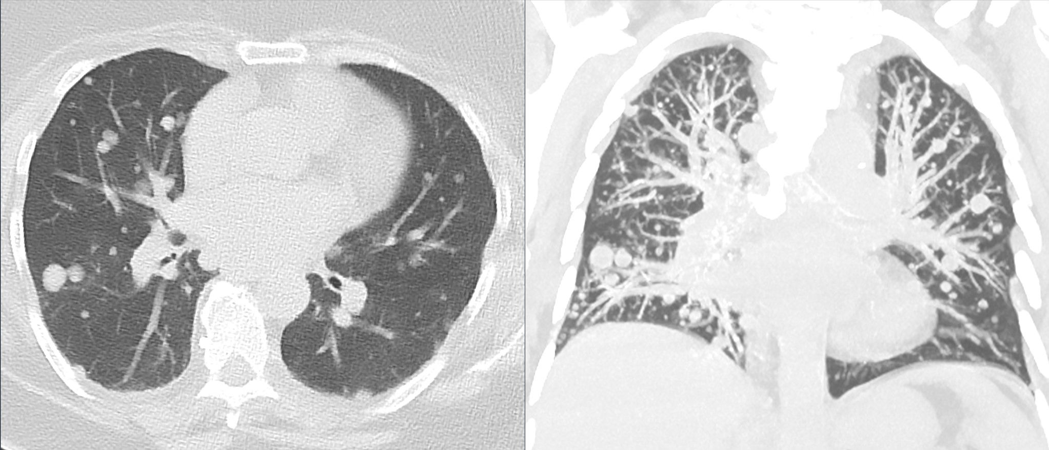 Tomografia de tórax (axial à esquerda, reconstrução MIP coronal à direita): múltiplos nódulos pulmonares metastáticos bilaterais, padrão de soltura de balões.