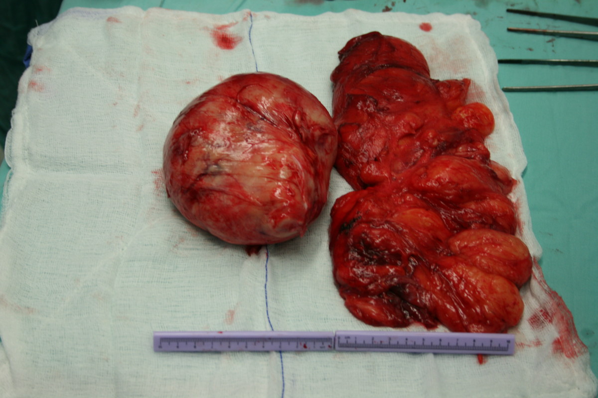 Peça de ressecção de lipossarcoma sobre o campo cirúrgico, com régua de escala: o nódulo tumoral encapsulado e o componente ressecado em bloco com tecido sadio adjacente — a margem que permite preservar o membro em vez de amputar.