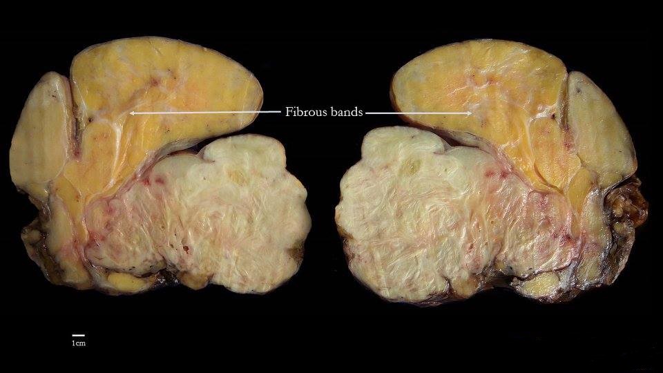 Peça macroscópica de lipossarcoma retroperitoneal bisseccionado: componente gorduroso amarelo e componente sólido esbranquiçado separados por bandas fibrosas, com régua de escala em centímetros.
