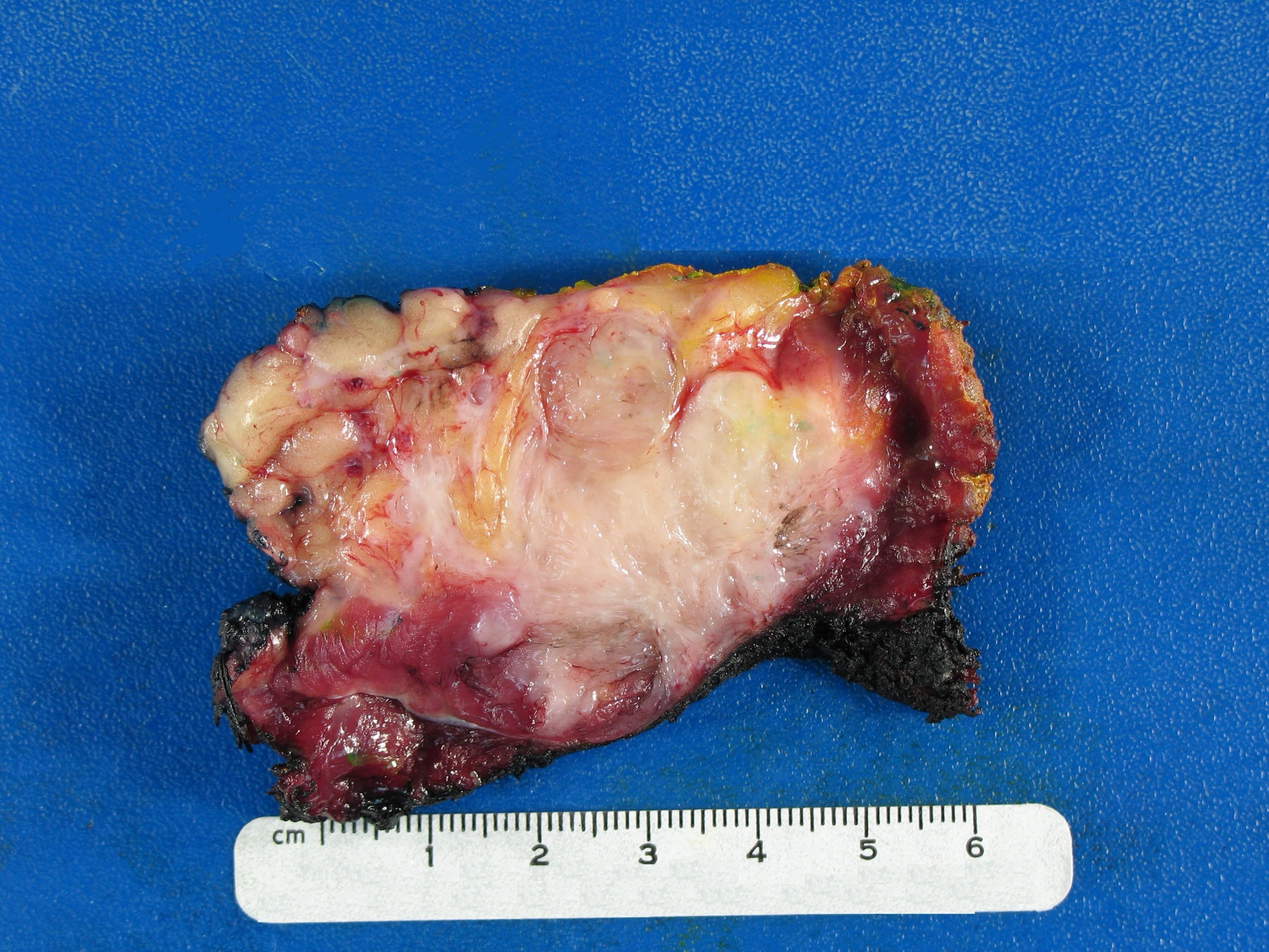 Peça de fibromatose desmoide: superfície de corte branca e fibrosa em redemoinho, infiltrando o músculo (vermelho) e a gordura (amarelo) adjacentes — sem plano de clivagem.
