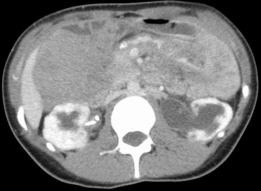 Tomografia computadorizada mostrando tumor desmoide: massa de partes moles infiltrativa.