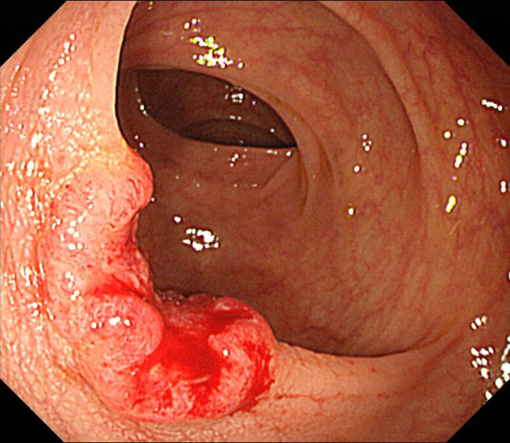 Colonoscopia mostrando adenocarcinoma colorretal vegetante: massa irregular avermelhada e friável que toma a luz do intestino, de bordas elevadas.