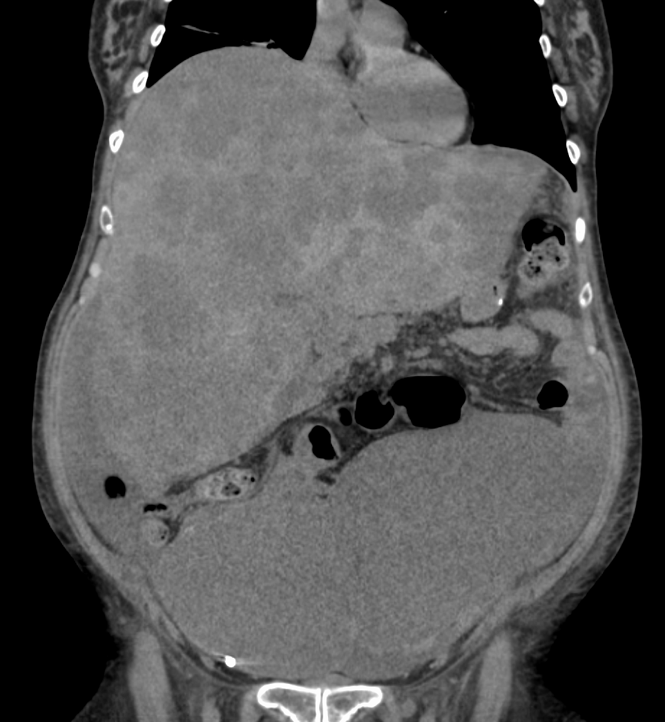 Tomografia de abdome mostrando fígado com múltiplos nódulos metastáticos hipodensos espalhados — o padrão 'pipocado' de fígado tomado por metástases de câncer colorretal.