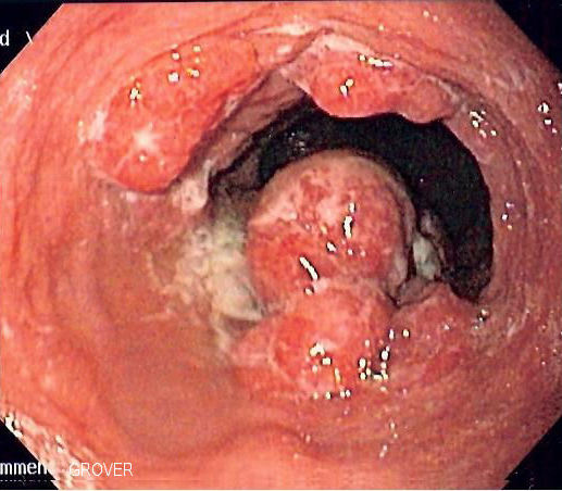 Endoscopia digestiva alta mostrando massa neoplásica vegetante na junção gastroesofágica — adenocarcinoma de esôfago distal, lesão luminal alvo de biópsia dirigida.