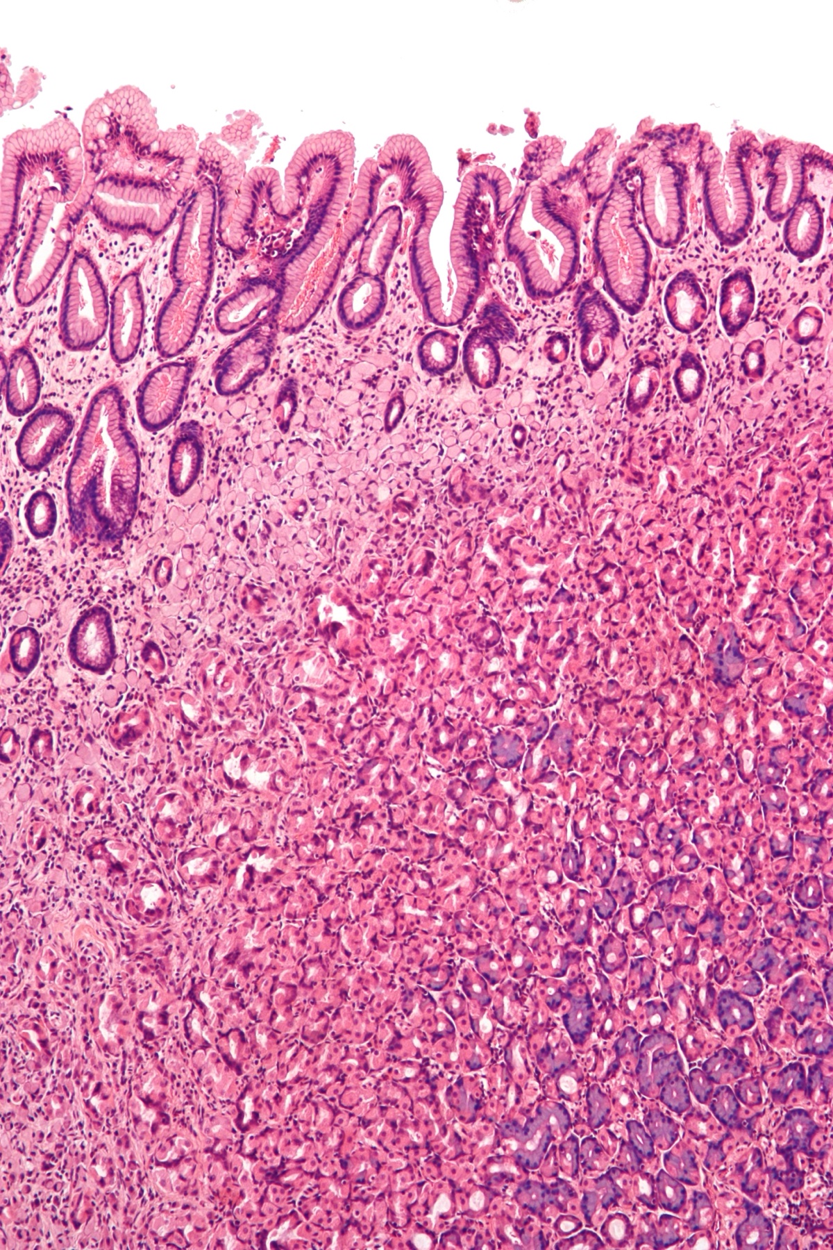 Micrografia (coloração hematoxilina-eosina) de adenocarcinoma gástrico difuso com células em anel de sinete: vacúolo citoplasmático de mucina empurrando o núcleo achatado para a periferia da célula.