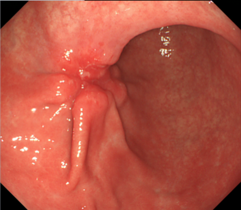 Endoscopia digestiva alta mostrando câncer gástrico tipo Borrmann III (ulceroinfiltrativo) no corpo do estômago: lesão ulcerada de bordas irregulares com mucosa adjacente nodular.