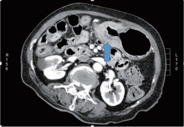 Tomografia computadorizada axial de abdome em câncer gástrico mostrando espessamento difuso da parede gástrica estendendo-se do corpo ao antro, indicado por seta.
