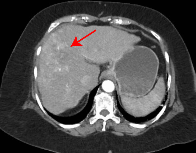 TC trifásica de hepatocarcinoma, fase arterial: a lesão fica mais clara (hipercaptante) que o fígado ao redor, indicada por seta.