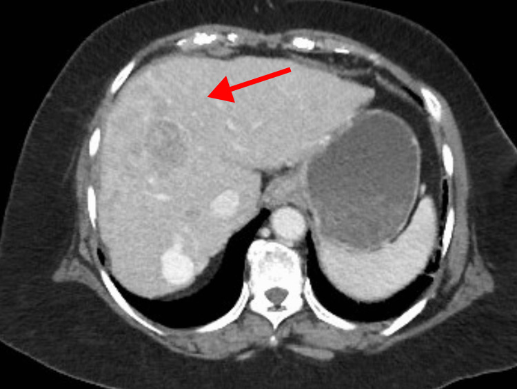 TC trifásica de hepatocarcinoma, fase tardia: a lesão está acentuadamente mais escura (hipodensa) que o parênquima — washout consolidado.