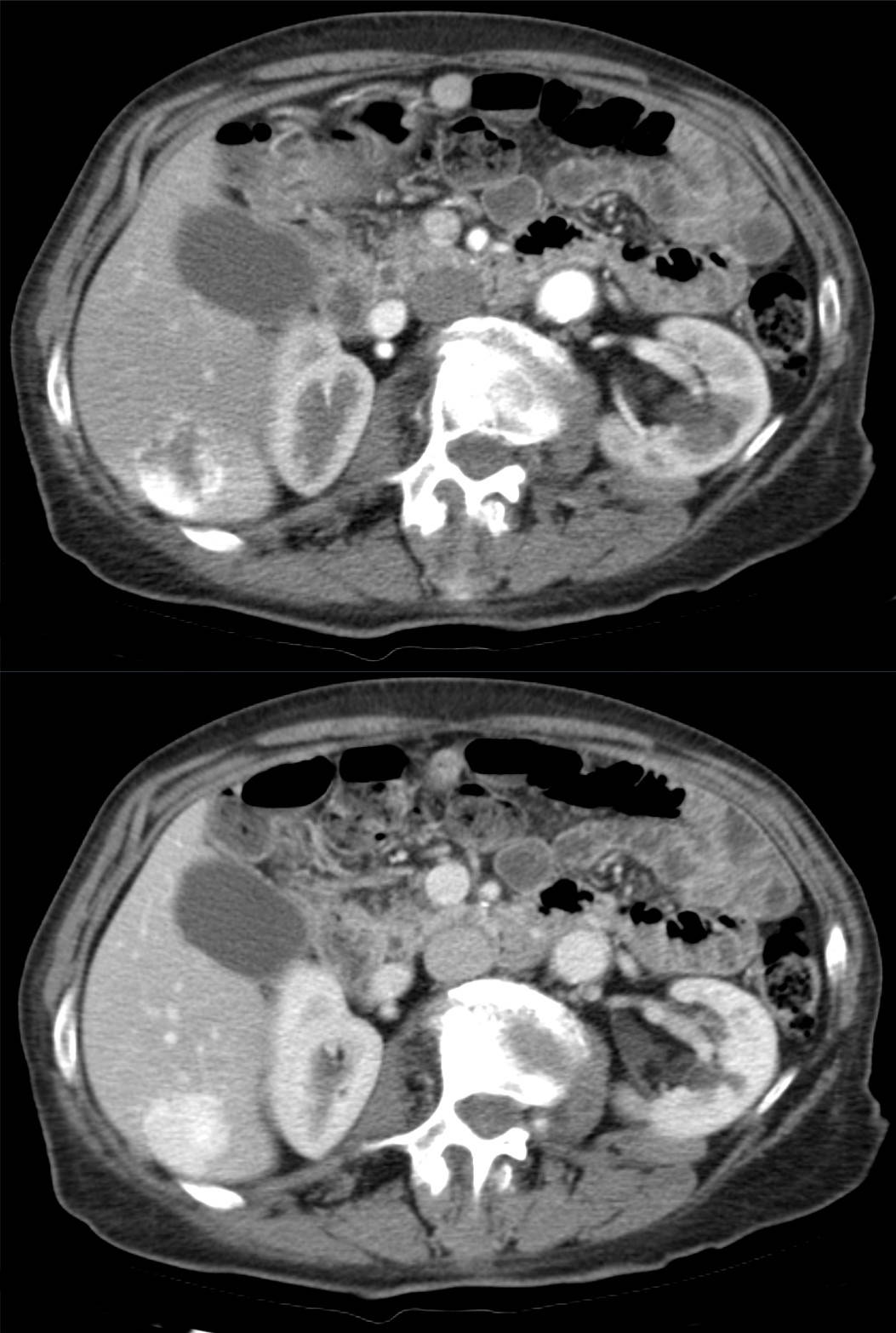 TC dinâmica de hemangioma hepático: na fase arterial (acima), captação intensa em glóbulos na periferia da lesão; na fase portovenosa (abaixo), o contraste preenche da borda para o centro — padrão centrípeto característico.