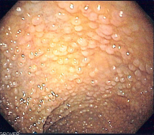 Sigmoidoscopia em polipose adenomatosa familiar: incontáveis pólipos pequenos recobrindo difusamente a mucosa colônica, o aspecto de tapete.