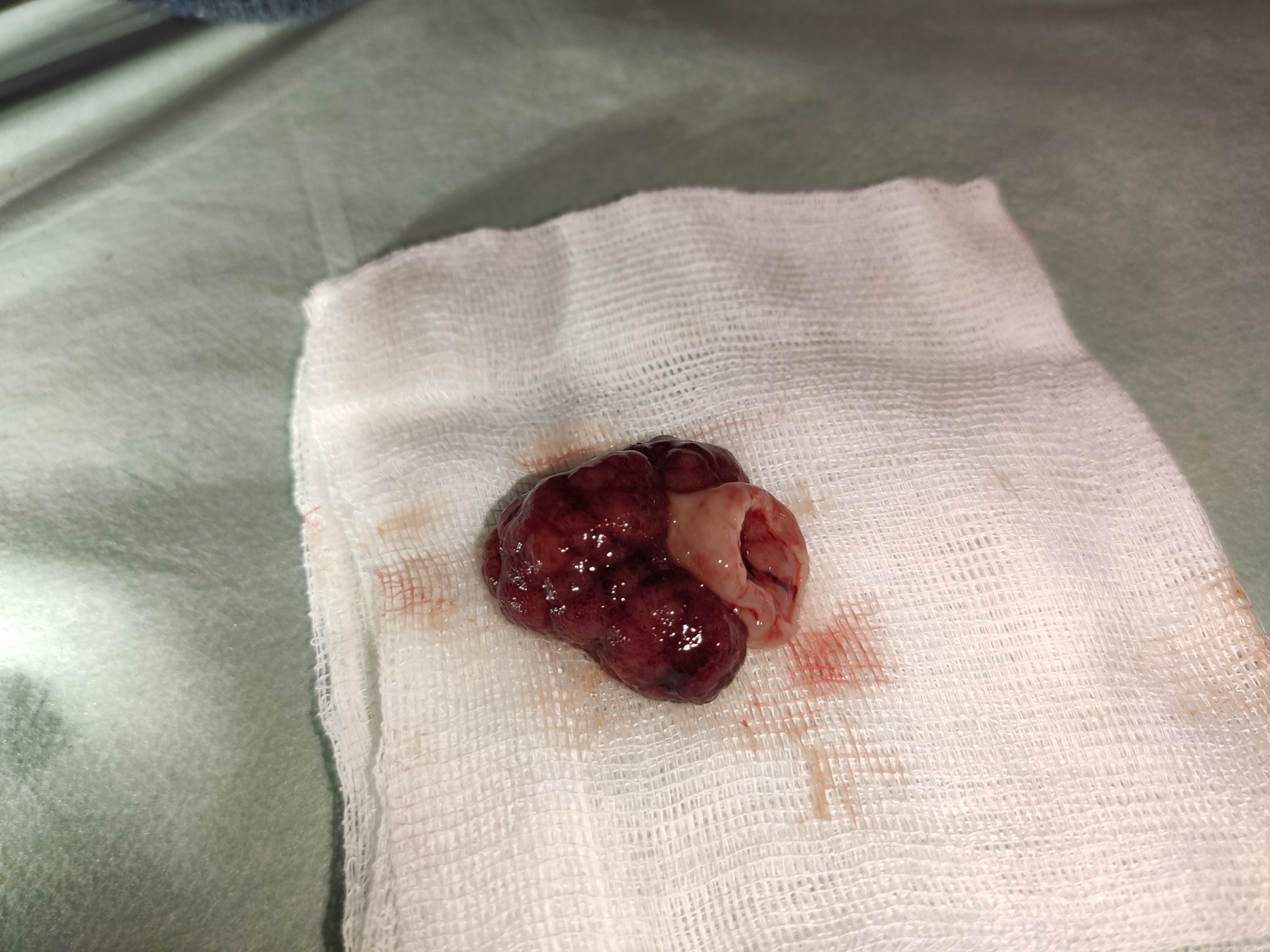 Peça de pólipo colorretal pediculado: cabeça arredondada vermelho-escura presa por um pedículo (haste) esbranquiçado.