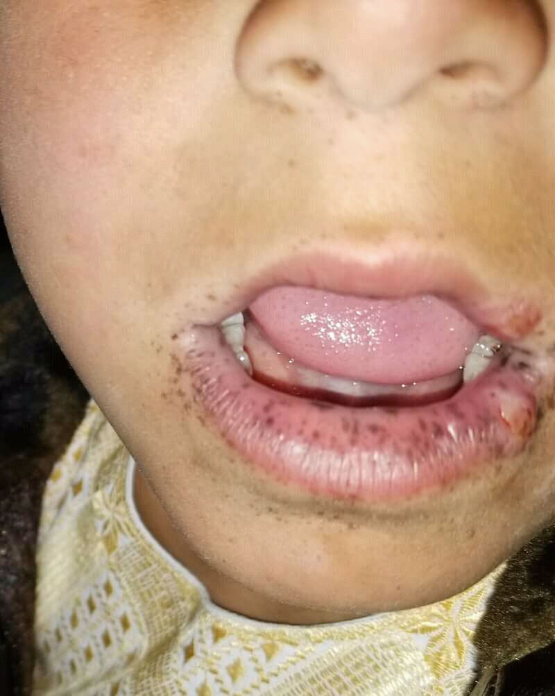 Pigmentação melanótica mucocutânea perilabial e labial: múltiplas máculas escuras concentradas ao redor e sobre os lábios, achado patognomônico da síndrome de Peutz-Jeghers.