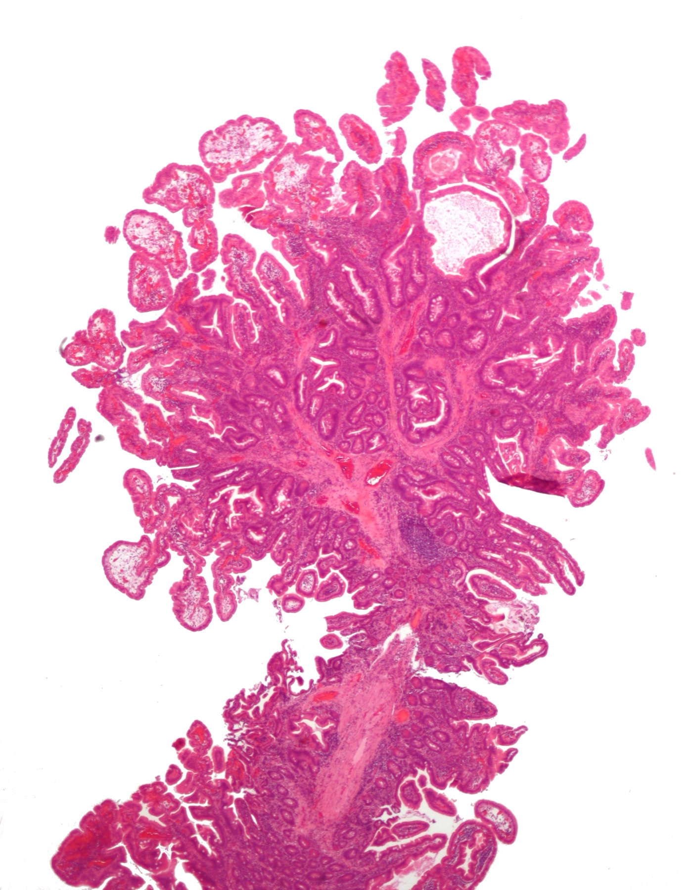 Histologia de pólipo hamartomatoso de Peutz-Jeghers: arborização ramificada de músculo liso revestida por epitélio glandular, sem displasia adenomatosa.