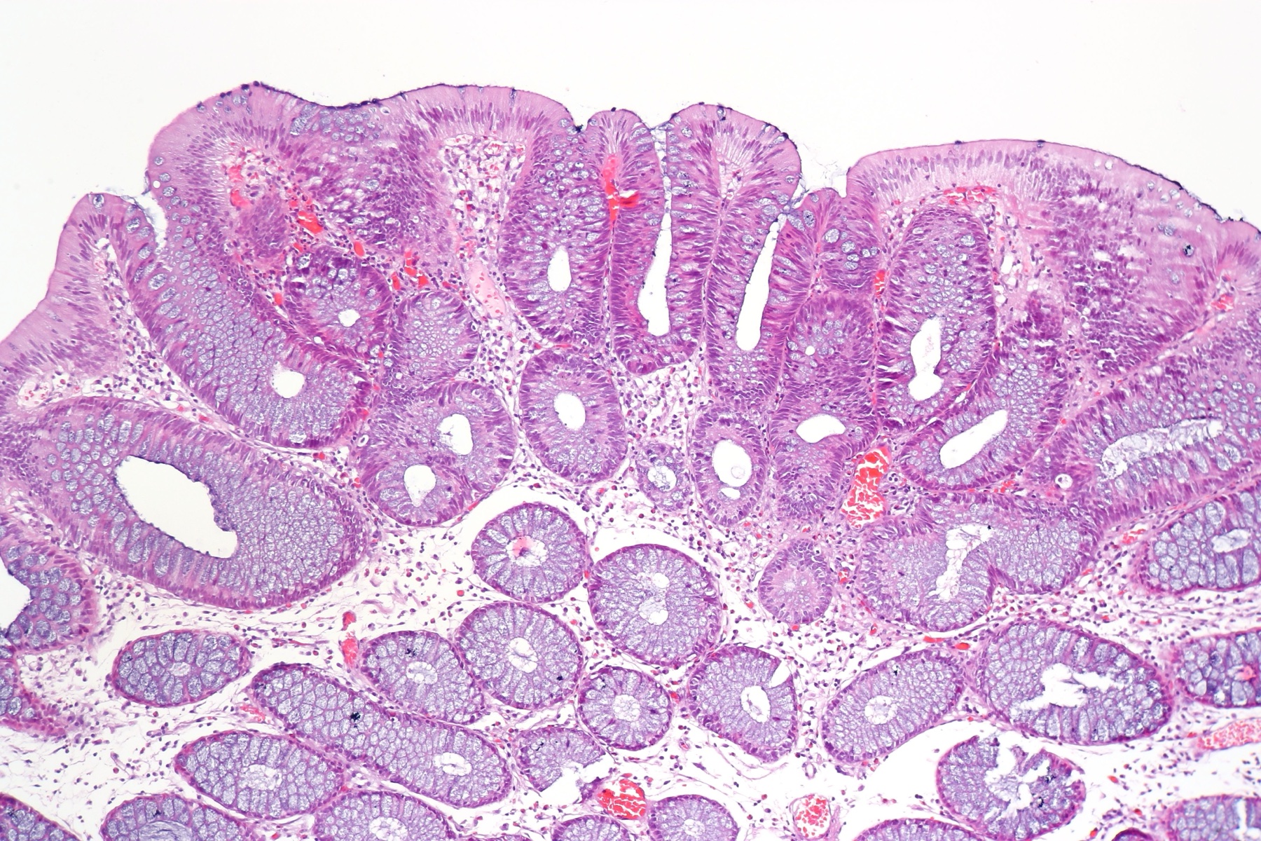 Histologia de adenoma tubular do cólon (H&E): glândulas tubulares arredondadas e regulares, arquitetura de menor risco.