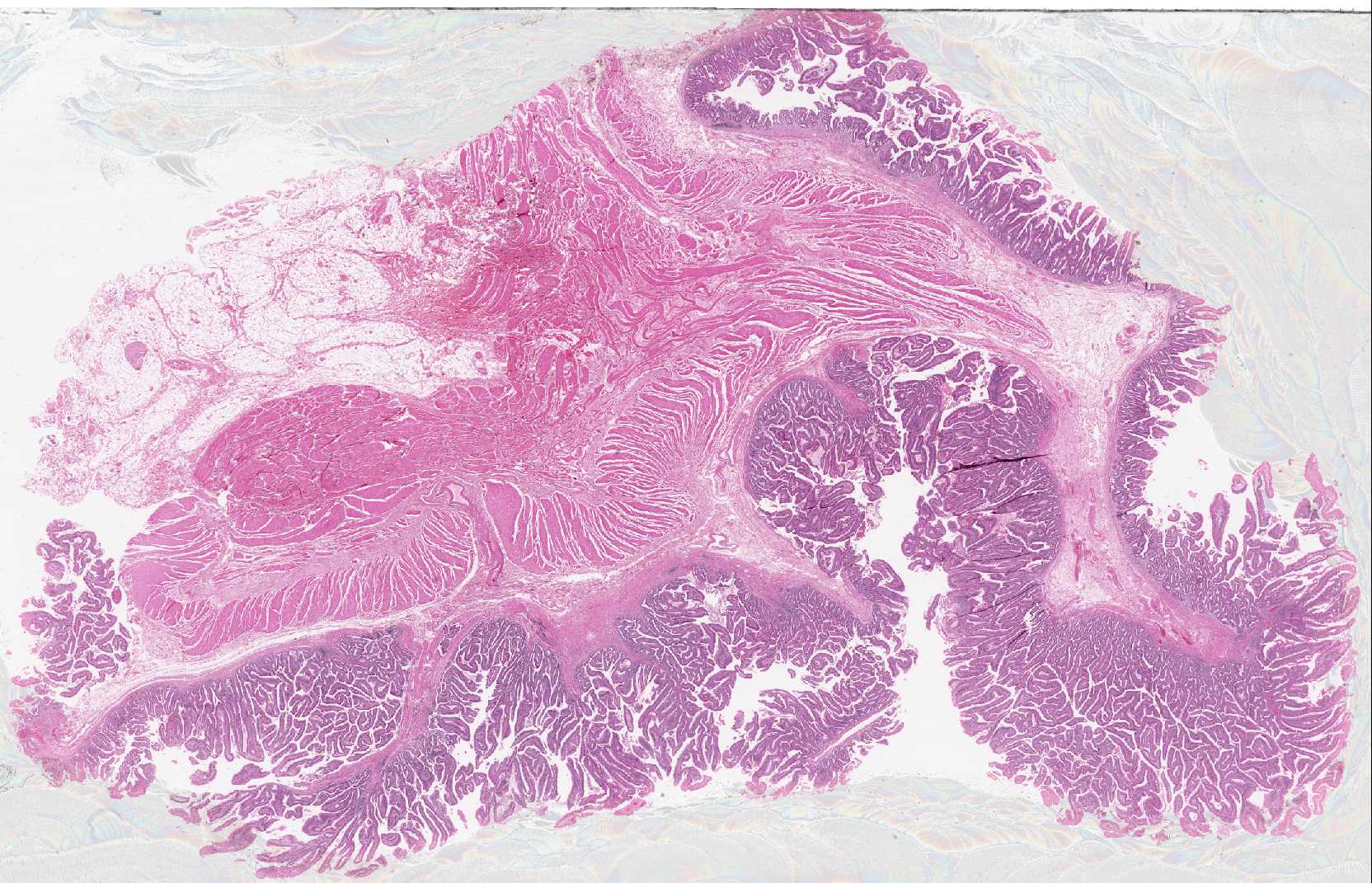 Histologia de adenoma viloso do cólon (H&E, baixo aumento): projeções vilositárias longas e finas em fronde, arquitetura de maior risco de malignização.